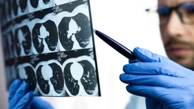 Computertomographie der Lunge