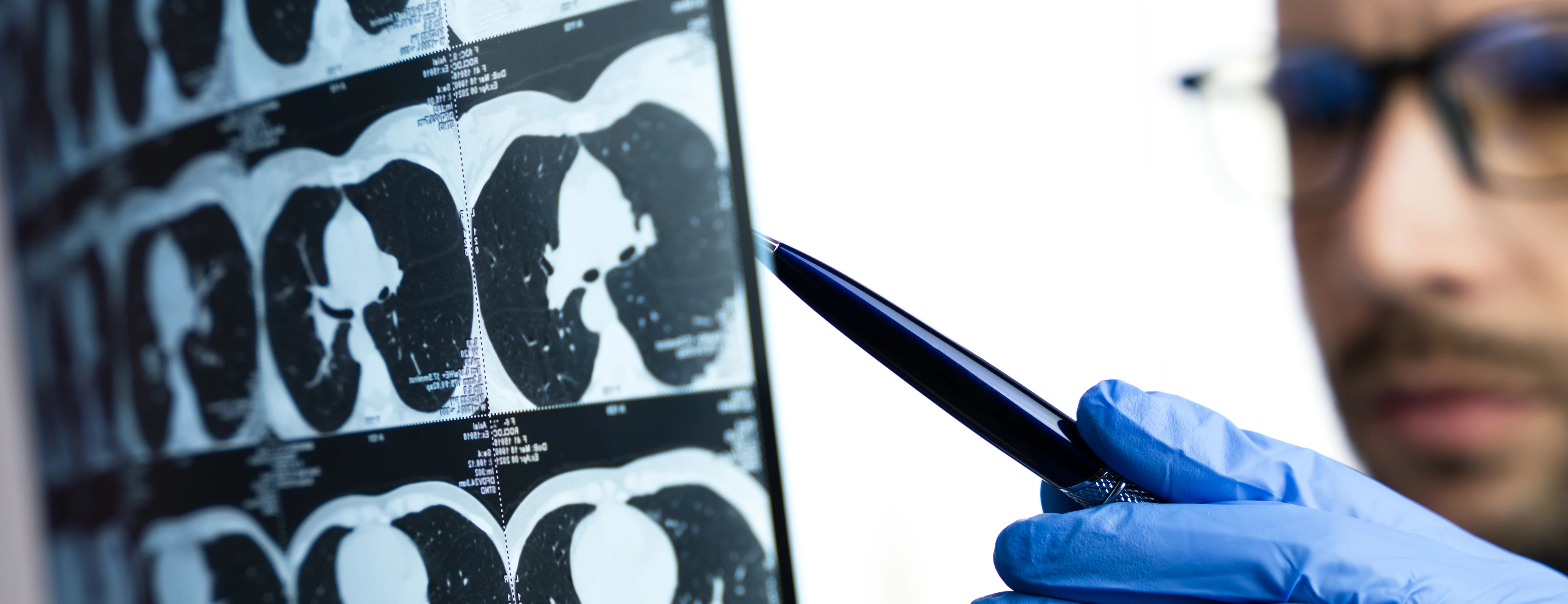 Computertomographie der Lunge