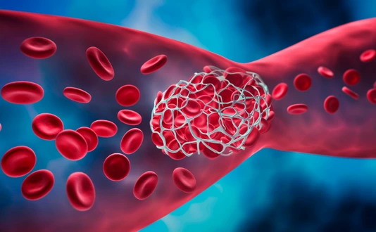 Blood clot blocking a blood vessel