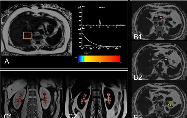 MRI images of ectopic fat quantification