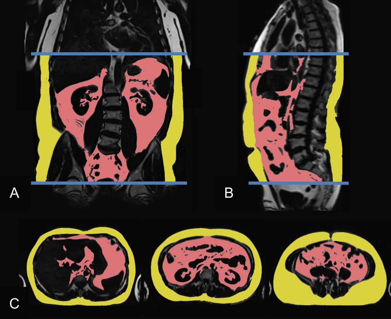 MRI-based assessment of visceral (VAT; red) and subcutaneous (SAT; yellow) adipose tissue in a 46-year-old male (VAT 6.57 l)