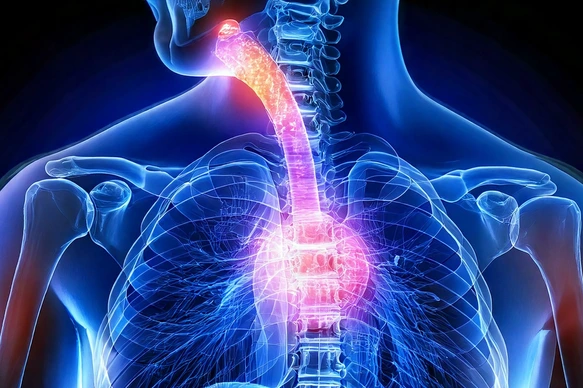 Esophageal Cancer