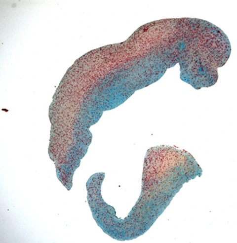 Movat-Pentachrome-Färbung einer Atherektomieprobe