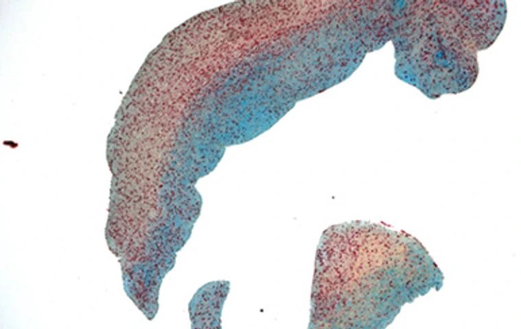 Movat-Pentachrome-Färbung einer Atherektomieprobe