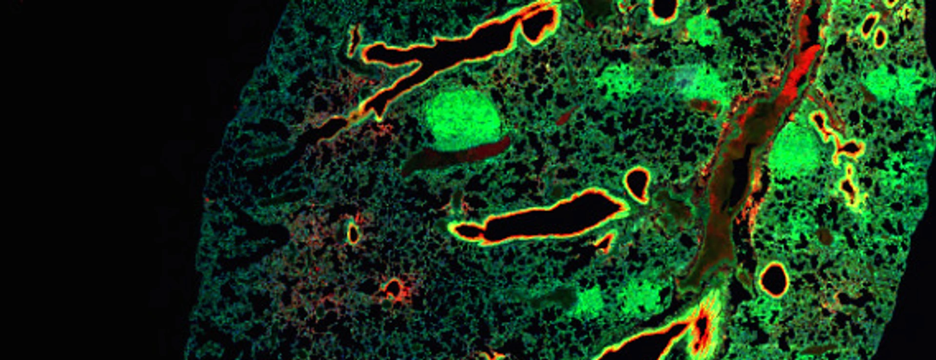 Large lesions represent lung tumours