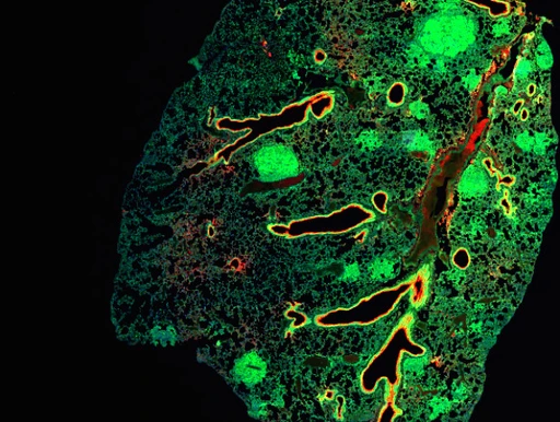 Large lesions represent lung tumours