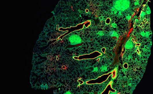 Large lesions represent lung tumours