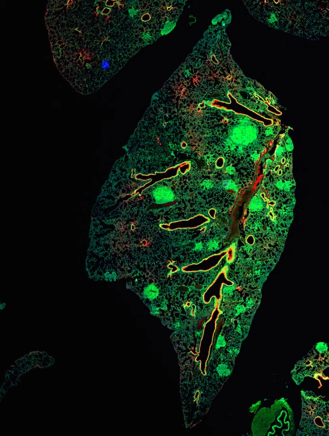 Lung tissue with green-stained primary tumors