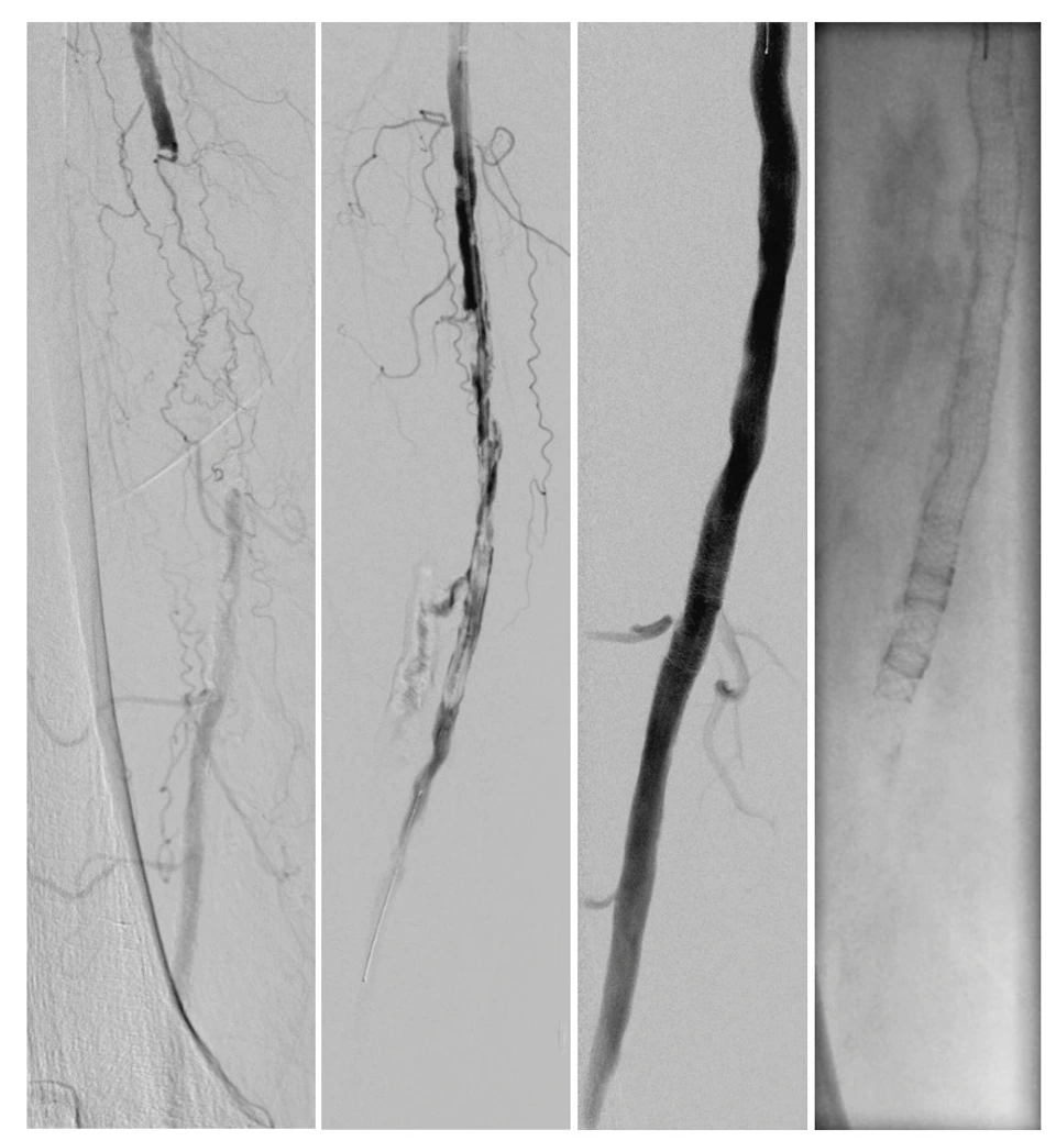 Revaskularisation der Arteria femoralis superficialis