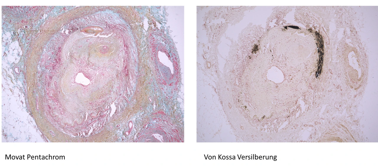 Querschnitt Posterior Tibial Arterie