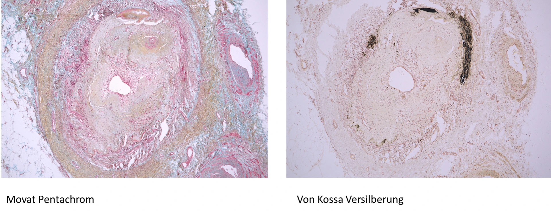Querschnitt Posterior Tibial Arterie