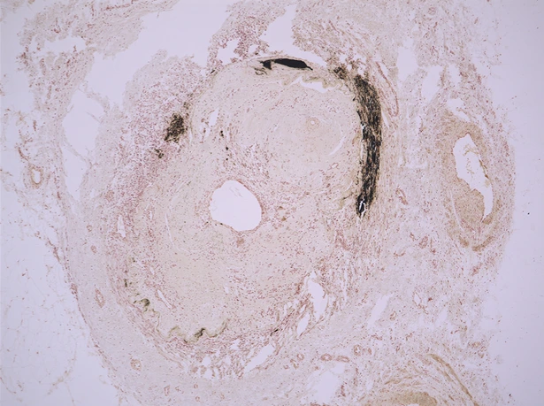 Querschnitt Posterior Tibial Arterie