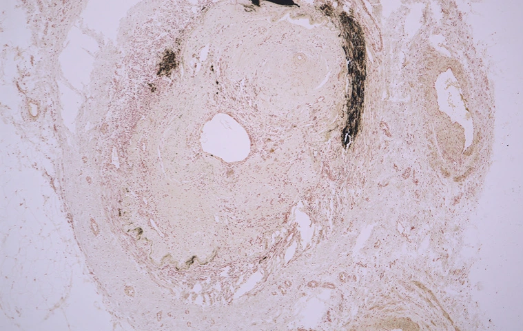 Querschnitt Posterior Tibial Arterie