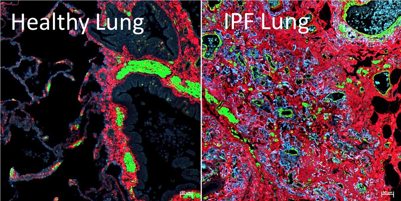 lhi-burgstaller-comparison-healthy-ipf-lung