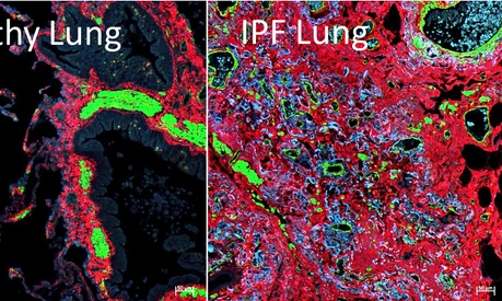 lhi-burgstaller-comparison-healthy-ipf-lung