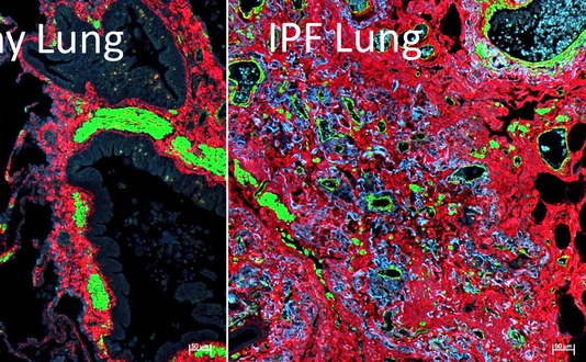 lhi-burgstaller-comparison-healthy-ipf-lung