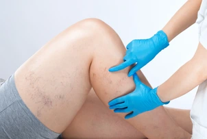 doctor shows  the dilation of small blood vessels of the skin on the leg. Medical inspection and treatment of Telangiectasia. sclerotherapy procedure