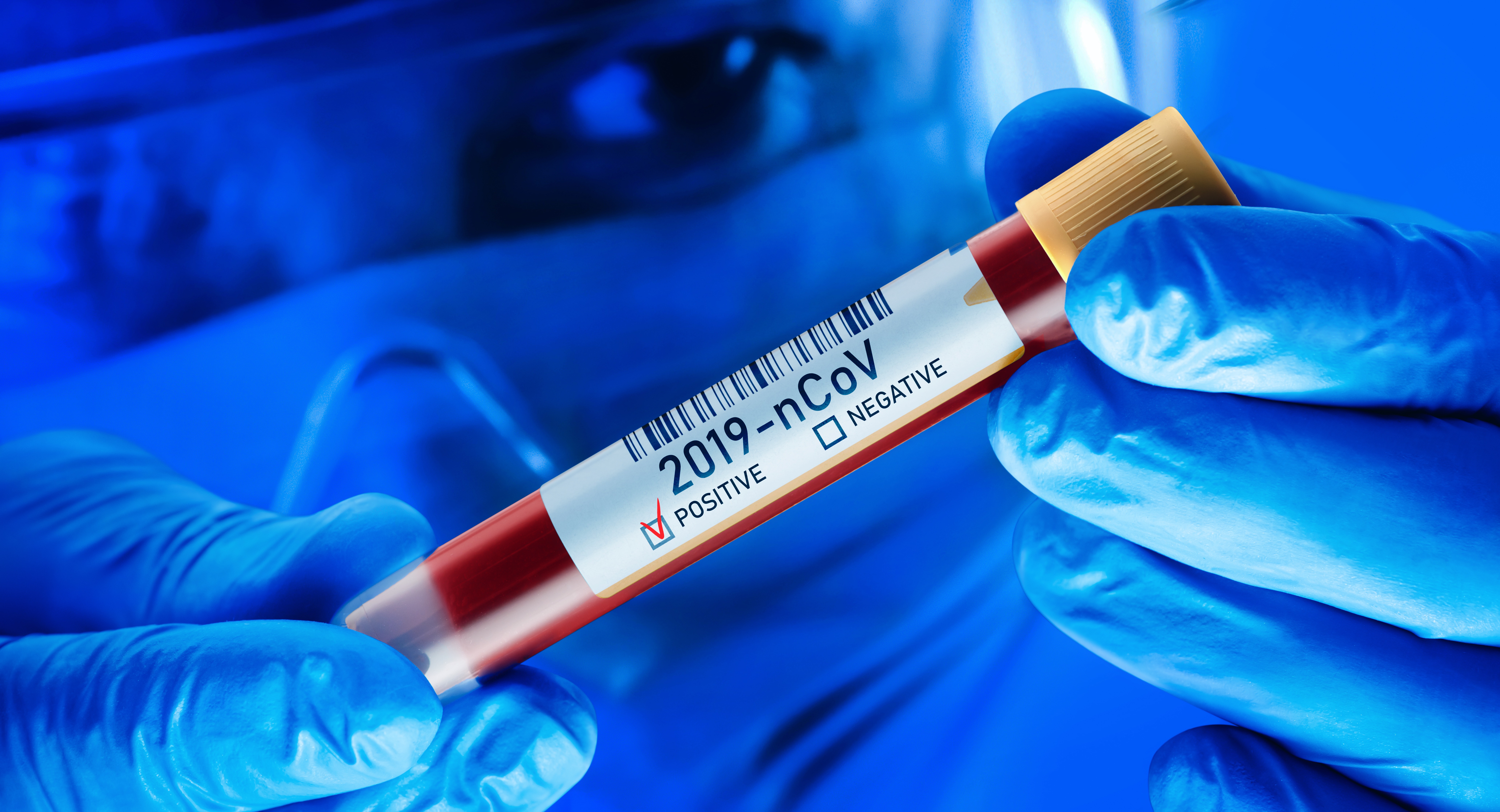 2019-nCoV Corona Virus Blood Test Concept