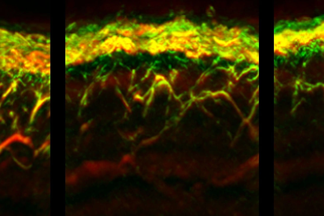 RSOM images of the skin of a healthy subject (left), a patient with diabetes (middle), and a patient with diabetes and neuropathy (right)