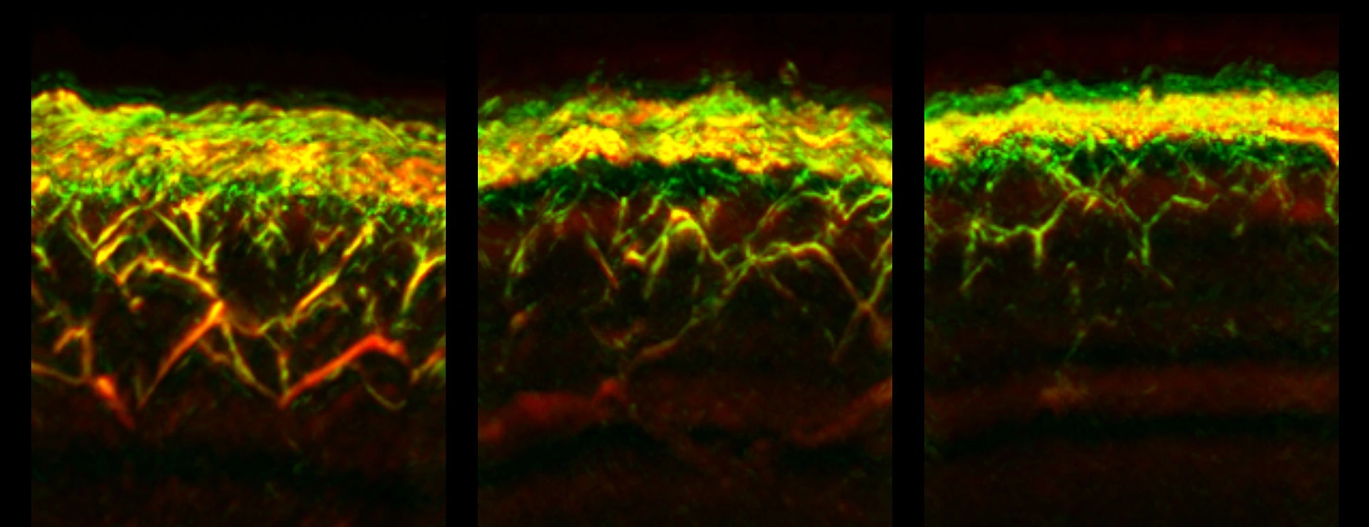 RSOM images of the skin of a healthy subject (left), a patient with diabetes (middle), and a patient with diabetes and neuropathy (right)