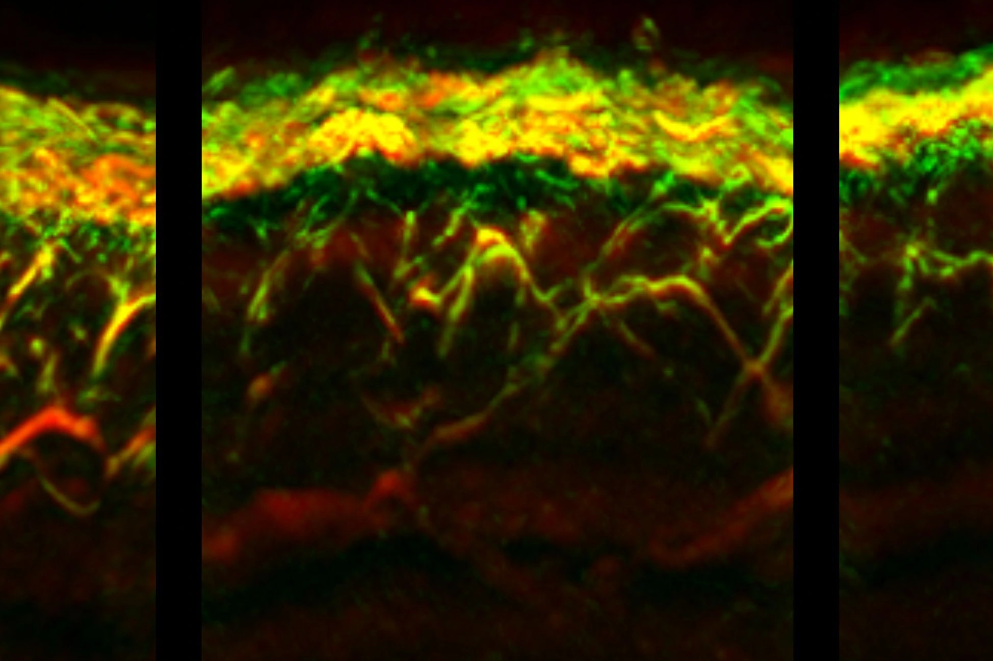 RSOM-Bilder der Haut: gesund (links), Diabetes (Mitte), Diabetes mit Neuropathie (rechts)