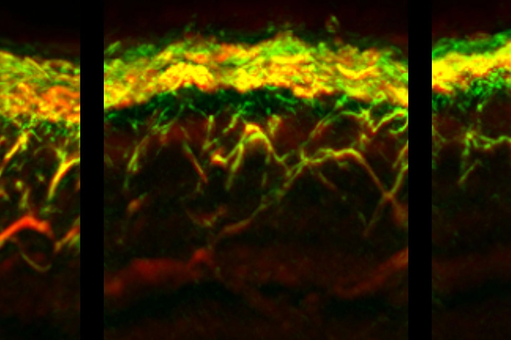 RSOM-Aufnahmen von Haut eines gesunden Probanden (links), eines Patienten mit Diabetes (mitte) und eines Patienten mit Diabetes und Neuropathie (rechts).