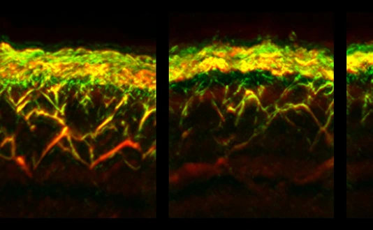 RSOM images of the skin of a healthy subject (left), a patient with diabetes (middle), and a patient with diabetes and neuropathy (right)