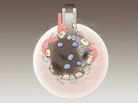 Graphic illustration of alveoli with COPD