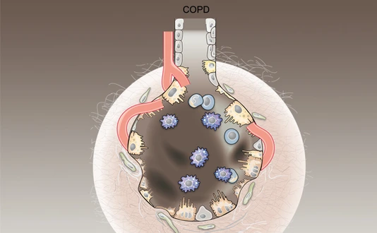 Graphic illustration of alveoli with COPD