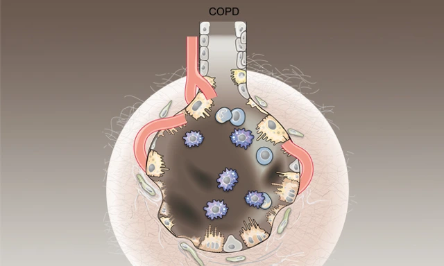 Graphic illustration of alveoli with COPD