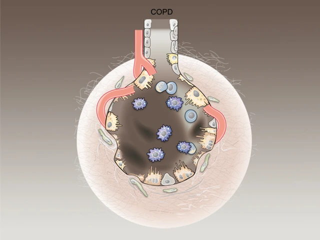 Graphic illustration of alveoli with COPD