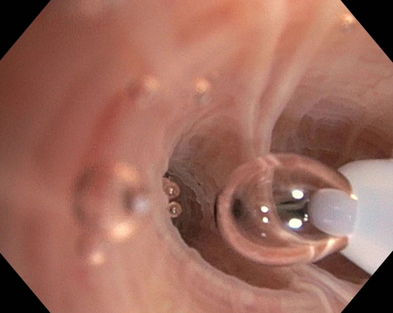 Bronchoalveoläre Lavage (BAL)