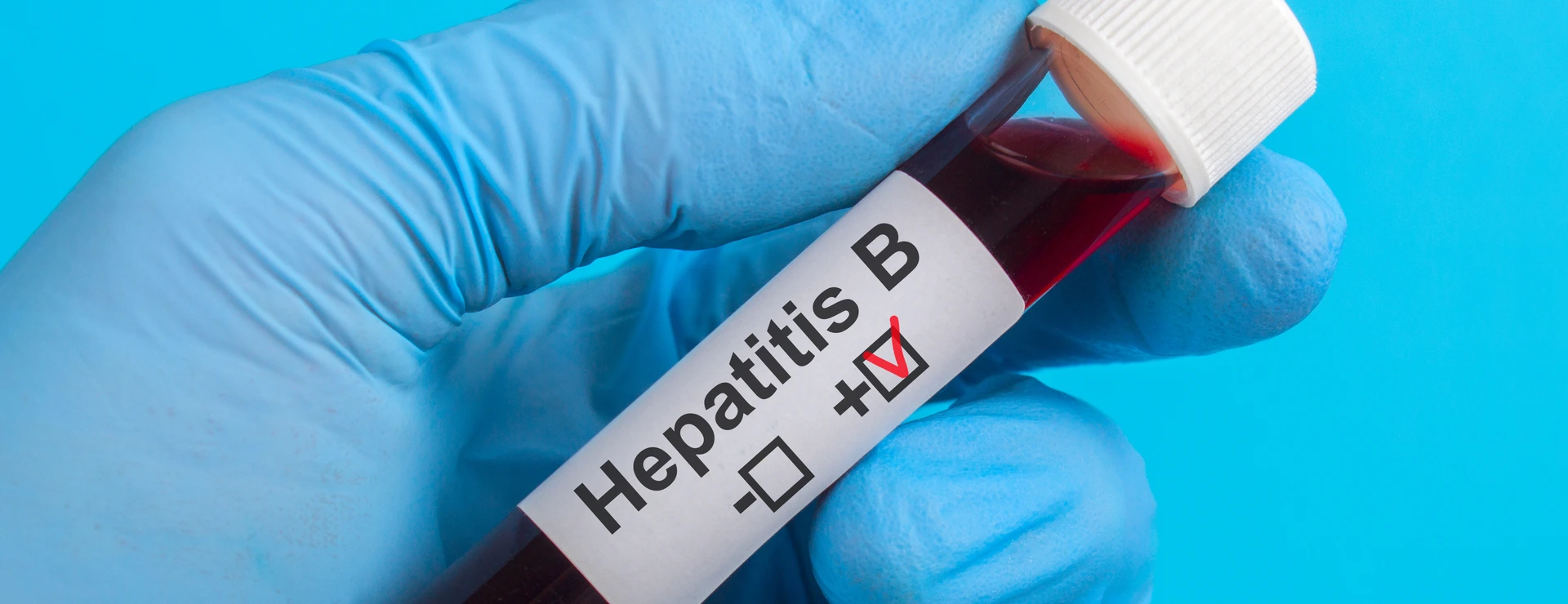 test vitro Hepatitis B HBV to the hand in glove on a blue background