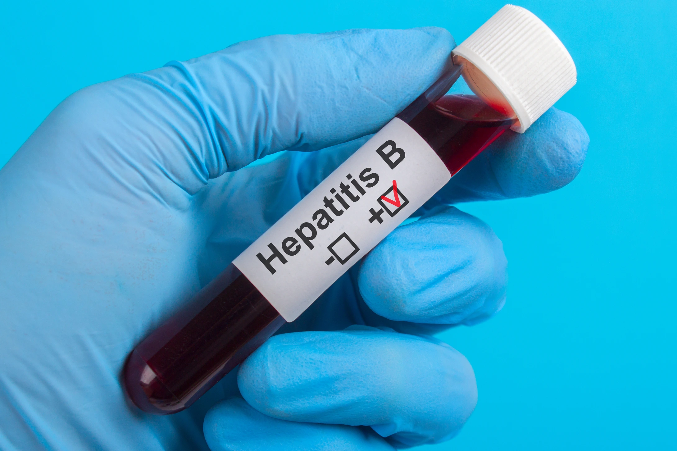 test vitro Hepatitis B HBV to the hand in glove on a blue background