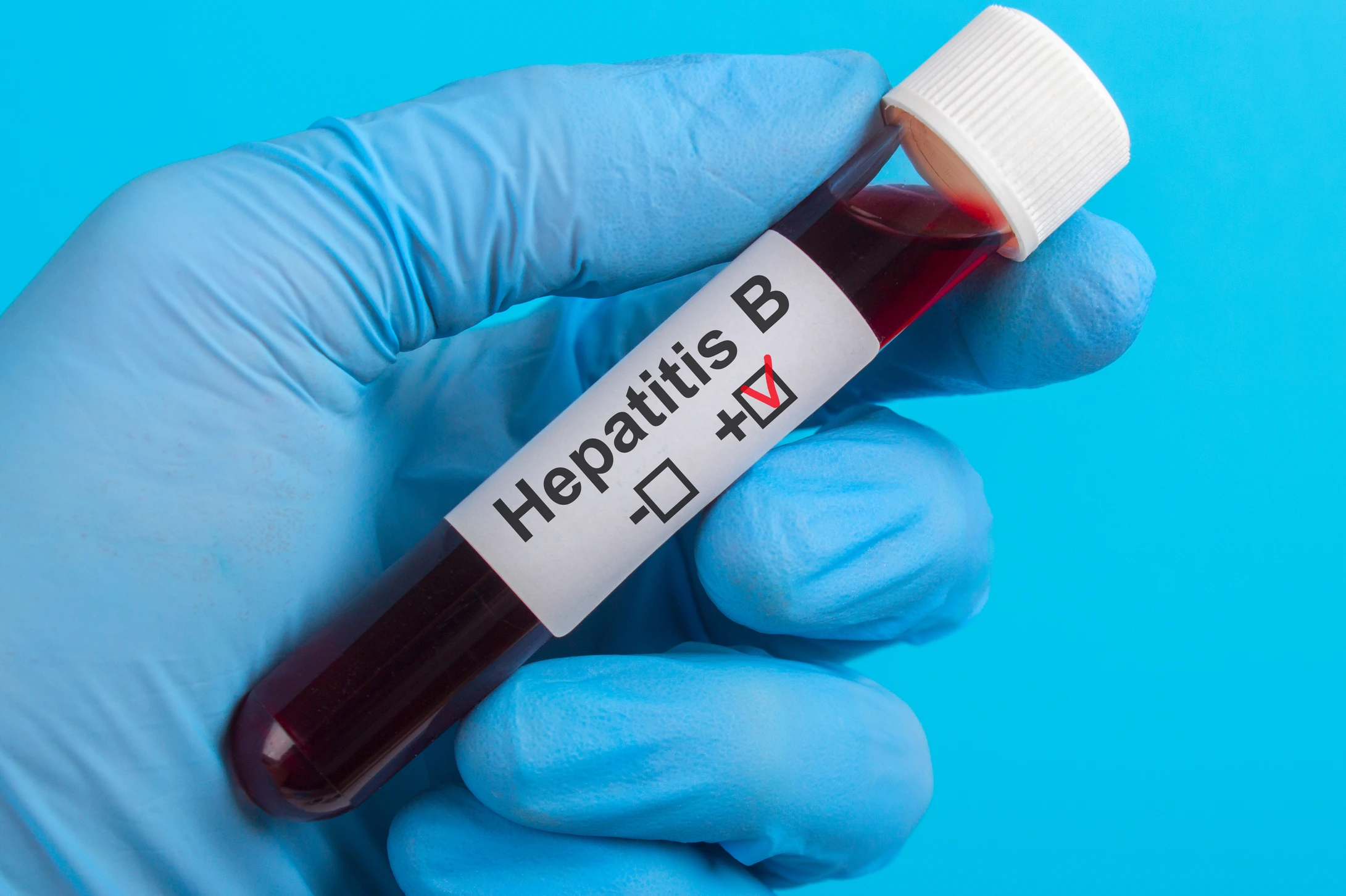 test vitro Hepatitis B HBV to the hand in glove on a blue background