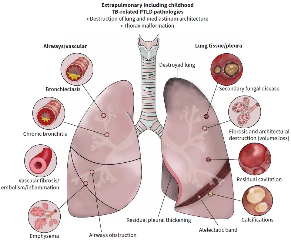 Picture4_ERS_postTB manifestations