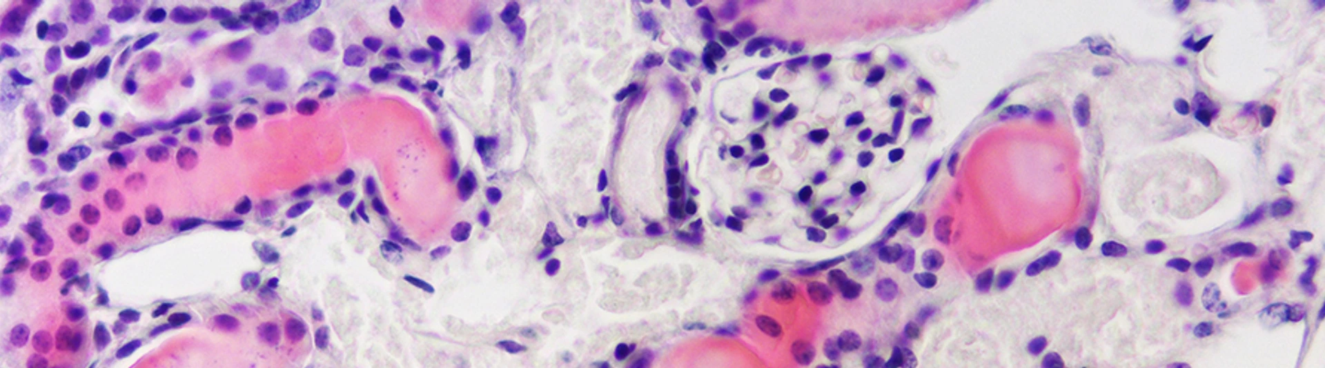 Kidney tubular cells dying by ferroptosis