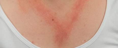 Kontaktallergie