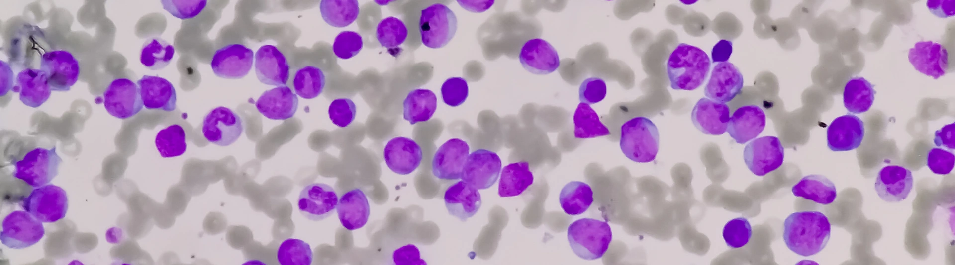 Leukemia cells