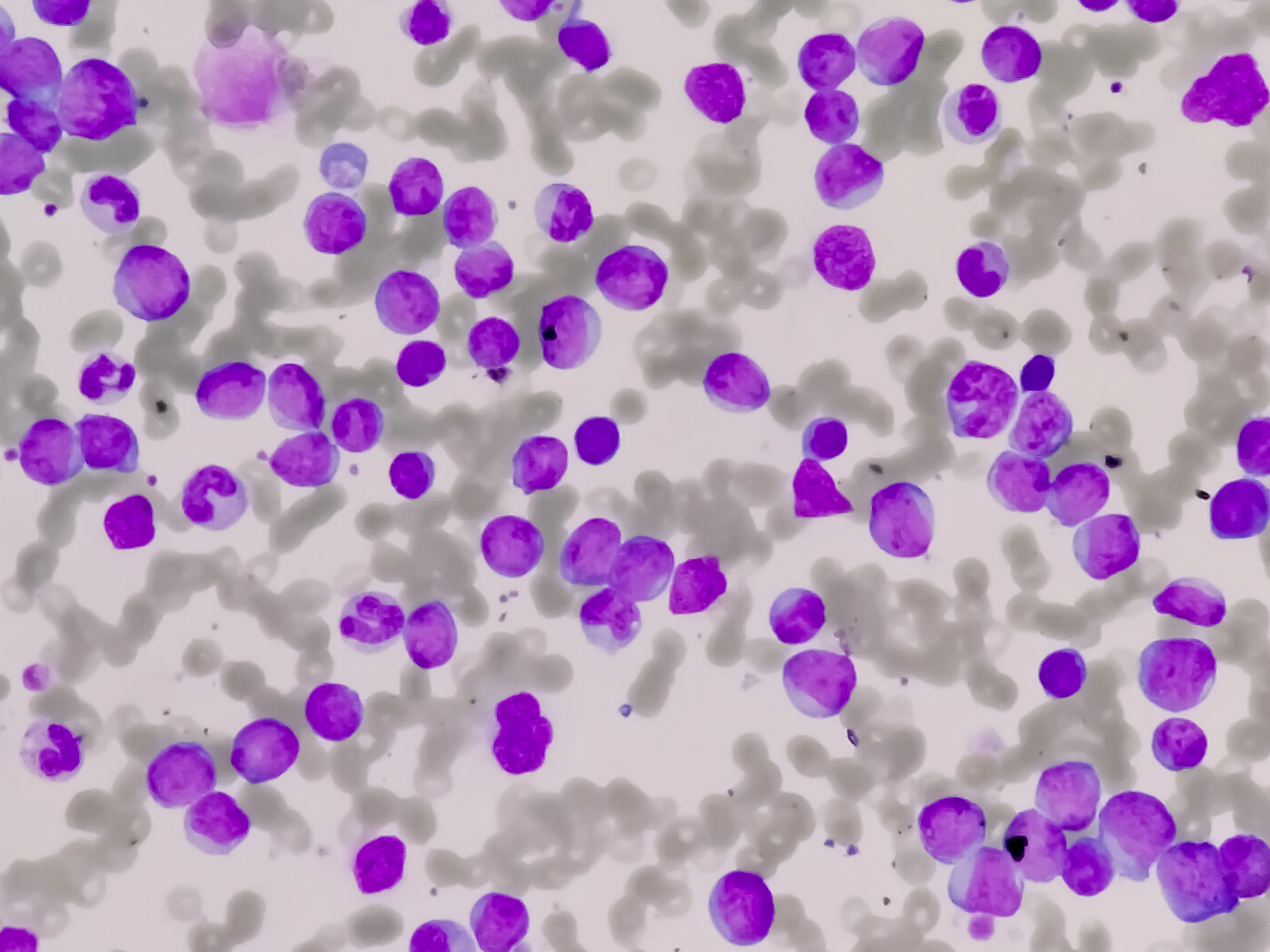 Leukemia cells