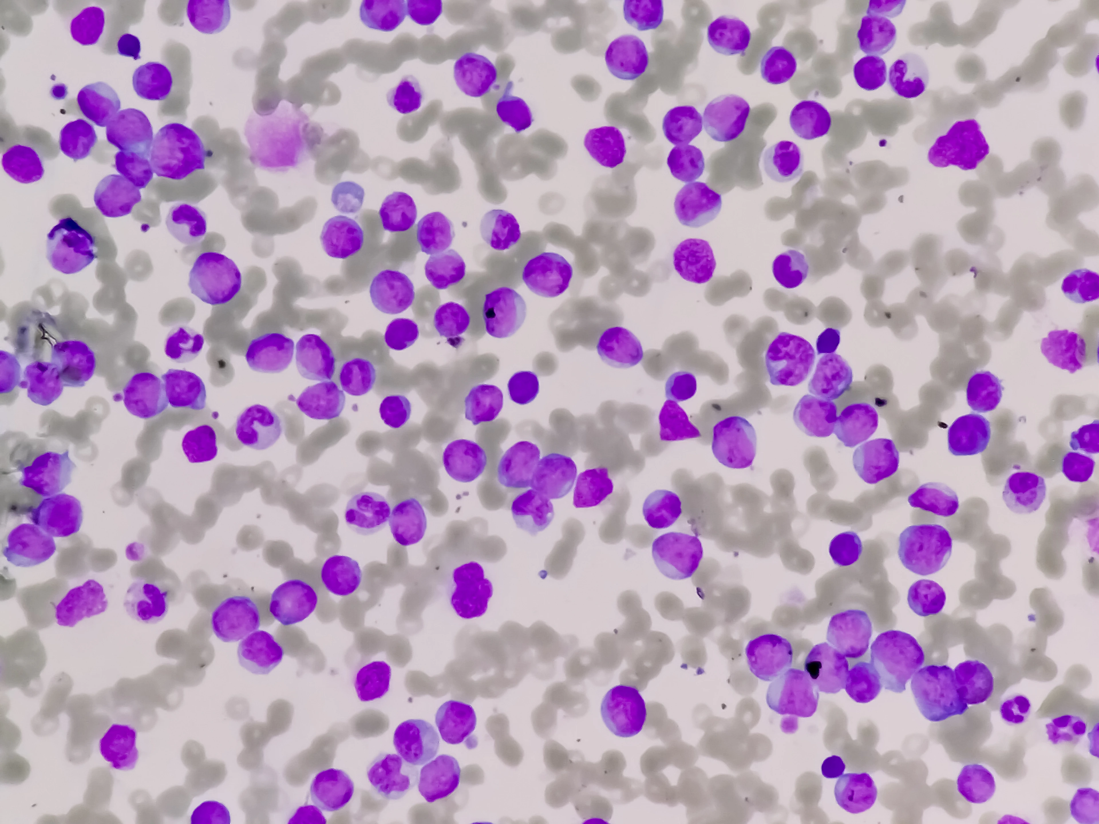 Leukemia cells