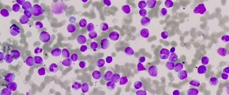 Leukemia cells