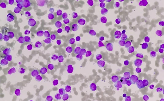 Leukemia cells