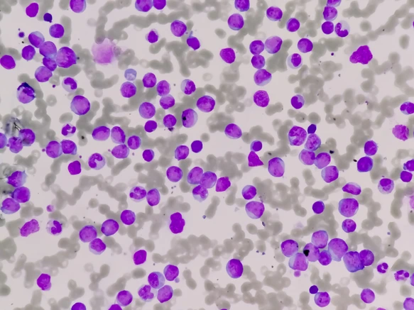 Leukemia cells