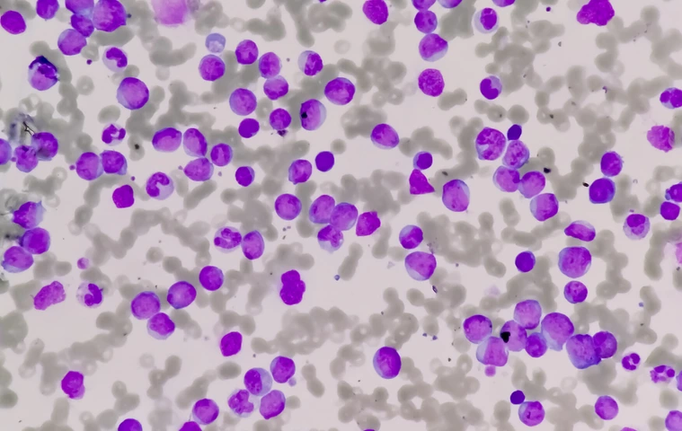 Leukemia cells