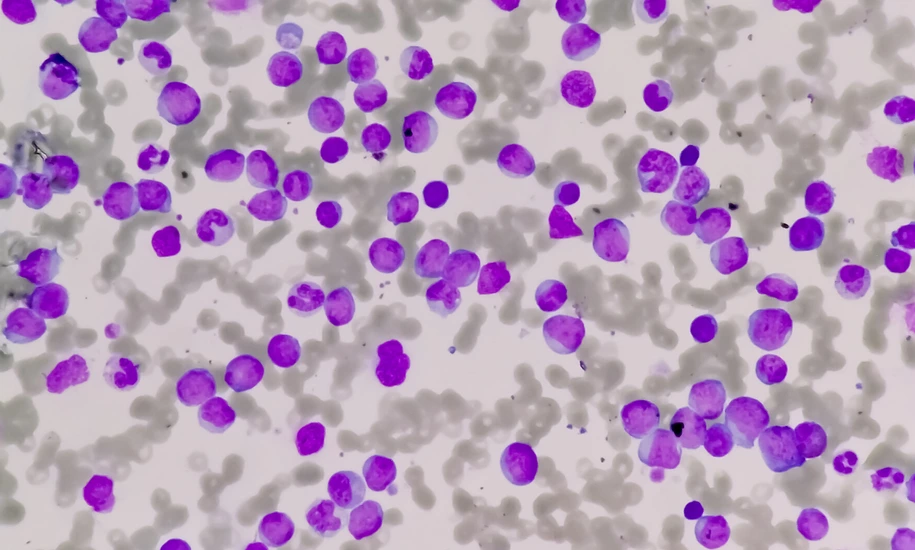 Leukemia cells