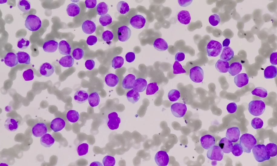 Leukemia cells