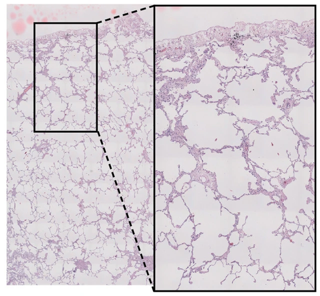 gerckens_muemmler_lab_pleural_effusion