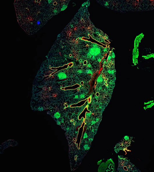 lung tissue with primary tumors in green and club cells in red