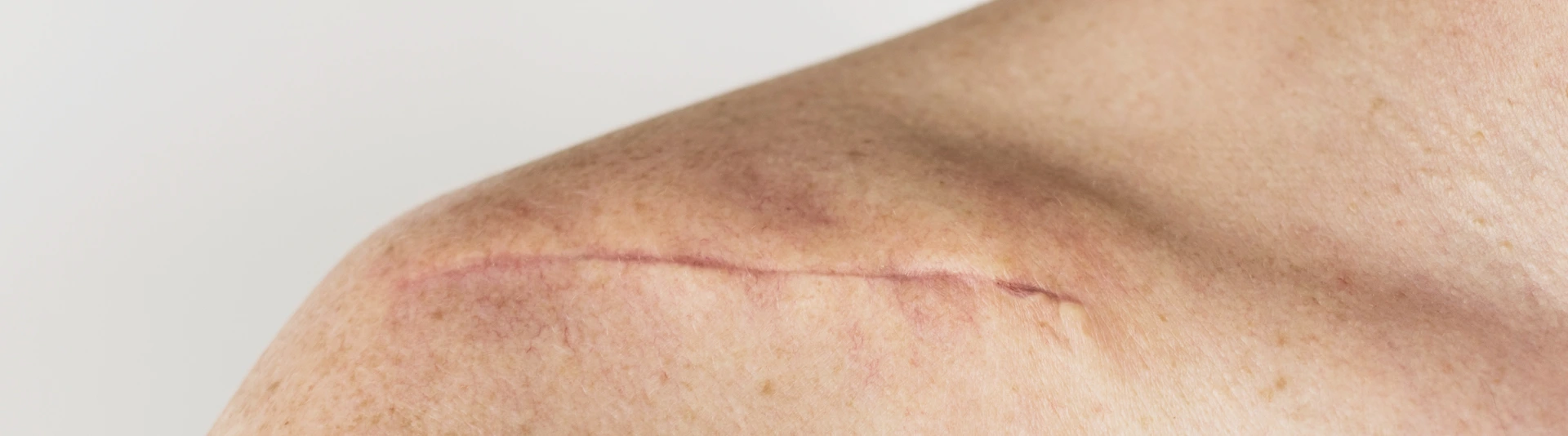 scar on the of a male body after surgery on a broken collarbone, acromion and shoulder